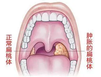 喉咙肿痛咽口水痛，晚上睡不好，不容忽视